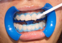 3 lý do vì sao bạn không nên tẩy trắng răng tại nhà