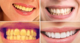 TOP cách làm trắng răng bị vàng HIỆU QUẢ đã được nhiều người áp dụng