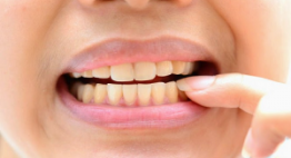 Răng bị ố vàng – Nguyên nhân hàng đầu khiến răng đổi màu