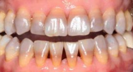 Tất tần tật rủi ro khi tẩy trắng răng bị ố vàng sai cách – Tìm hiểu ngay