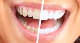 Bí quyết làm trắng răng hiệu quả nhanh, thực hiện đơn giản tại nhà.