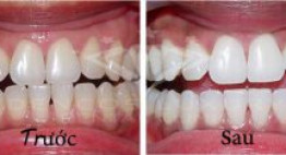 Dencos Luxury có nằm trong top nha khoa tẩy trắng răng hiệu quả nhất tại Hà Nội không?