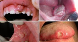 Bệnh răng miệng phổ biến – Phân loại, nguyên nhân & giải pháp khắc phục