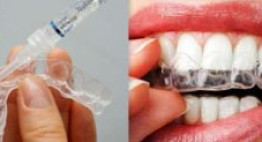 Phân tích ƯU – NHƯỢC ĐIỂM của phương pháp làm trắng răng bằng máng tẩy