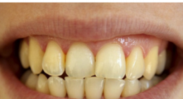 Răng bị vàng làm sao cho trắng – Giải pháp đánh bay ố vàng, xỉn màu nhanh chóng