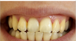 Răng vàng có tẩy trắng được không? – Sự thật bạn có thể chưa biết!