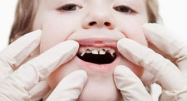 Bệnh răng miệng ở trẻ em & Phương pháp điều trị AN TOÀN – HIỆU QUẢ