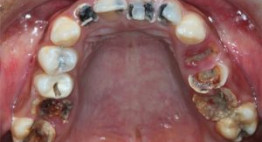 Bệnh sâu răng: Nguyên nhân – Triệu chứng – Phương pháp điều trị
