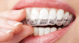 Chi phí tẩy trắng răng bằng máng khoảng bao nhiêu là phù hợp nhất?