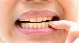 Có phải tẩy trắng răng thường xuyên không? – Bật mí từ chuyên gia