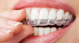 Công nghệ tẩy trắng răng bằng máng tẩy có thật sự tốt cho hàm răng?