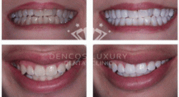 Quy trình làm trắng răng bằng máng tẩy chuẩn xác đến từng chi tiết