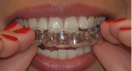 Tẩy trắng răng bằng máng tẩy răng có trắng lên không?