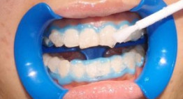 Sự thật về tẩy trắng răng Zoom White Perfect có đau không?