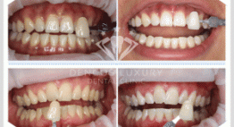 Tẩy trắng răng zoom whitening răng có trắng lên không?
