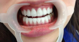 Một số lưu ý sau khi tẩy trắng răng bạn đừng bỏ qua
