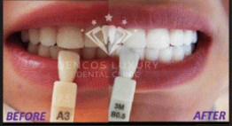 Làm trắng răng bao nhiêu tiền cho từng tình trạng răng bị vàng?