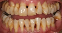 LIST nguyên nhân gây bệnh răng miệng & Cách phòng tránh