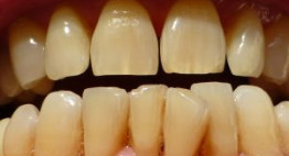 Tẩy trắng răng zoom whitening 1 lần duy nhất có trắng không?
