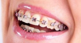 Phương pháp tẩy trắng răng sau khi niềng đáng kinh ngạc mà ai cũng nên biết