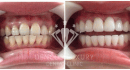 Cứu nguy hàm răng ố vàng với 2 giải pháp NHANH CHÓNG – HIỆU QUẢ