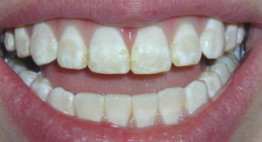 Làm trắng răng được bao lâu? – Kết quả của từng phương pháp