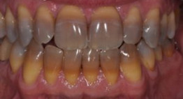 Sự thật bạn nên biết: Răng nhiễm màu Tetracyline nên tẩy trắng răng hay bọc răng sứ?