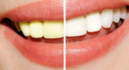 Bật mí từ chuyên gia nha khoa: Tẩy trắng răng bao lâu thì trắng?