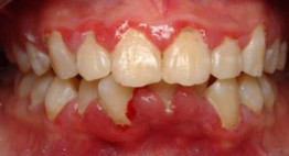 Bệnh nướu răng & Những tác hại nghiêm trọng cần sớm điều trị triệt để