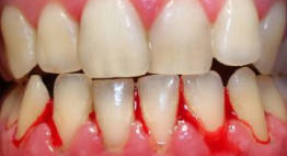 Chảy máu nướu răng là bệnh gì? [Hỏi đáp cùng chuyên gia]