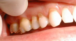 Răng nhạy cảm là gì? Nguyên nhân, triệu chứng và cách điều trị