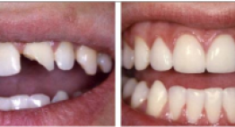 Cách khắc phục răng bị mẻ hiệu quả cao, nhanh chóng và an toàn