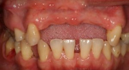 Bệnh tiêu xương răng là gì? Nguyên nhân và cách phòng ngừa bệnh