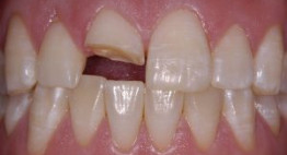 Đối phó hiệu quả với những nguyên nhân răng bị mẻ nghiêm trọng