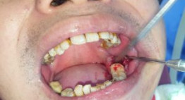 Nhổ răng khôn kiêng ăn gì để vết thương nhanh chóng hồi phục?