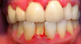 Bật mí các cách chữa bệnh viêm nướu răng cực kỳ hiệu quả ngay tại nhà