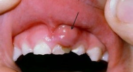 Điều trị viêm nướu răng ở trẻ em đảm bảo HIỆU QUẢ nhanh chóng