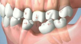 Bệnh tiêu xương răng có sao không? [Lời giải đáp của chuyên gia nha khoa]