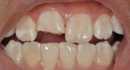 Giải pháp toàn diện phục hồi hàm răng bị sứt răng cửa