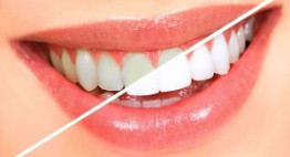 Bật mí từ chuyên gia: Tẩy trắng răng có đau không?