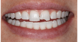 Răng bị mẻ – Nguyên nhân – Biện pháp đối phó hiệu quả tức thì