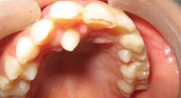 Rất nhiều người quan tâm: Nhổ răng thừa có nguy hiểm không?