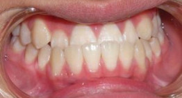 Răng móm có bọc sứ được không? – Biện pháp điều trị răng móm hiệu quả nhất