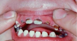 Có nên nhổ răng sâu cho trẻ không? [Tư vấn nha khoa]