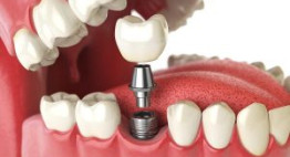 Trồng răng Implant khi mất răng hàm cần được tiến hành chất lượng như thế nào?