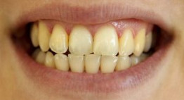 Răng bị ố vàng phải làm sao? – CHUYÊN GIA GIẢI ĐÁP THẮC MẮC