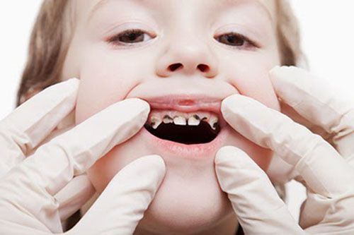 Bệnh răng miệng ở trẻ em