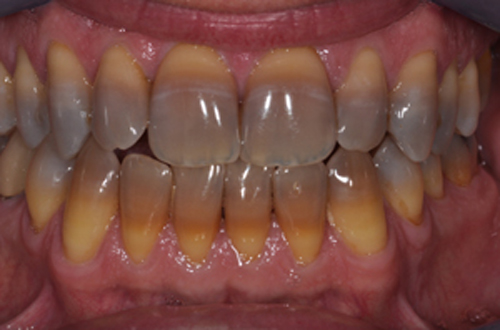 Răng nhiễm màu Tetracyline