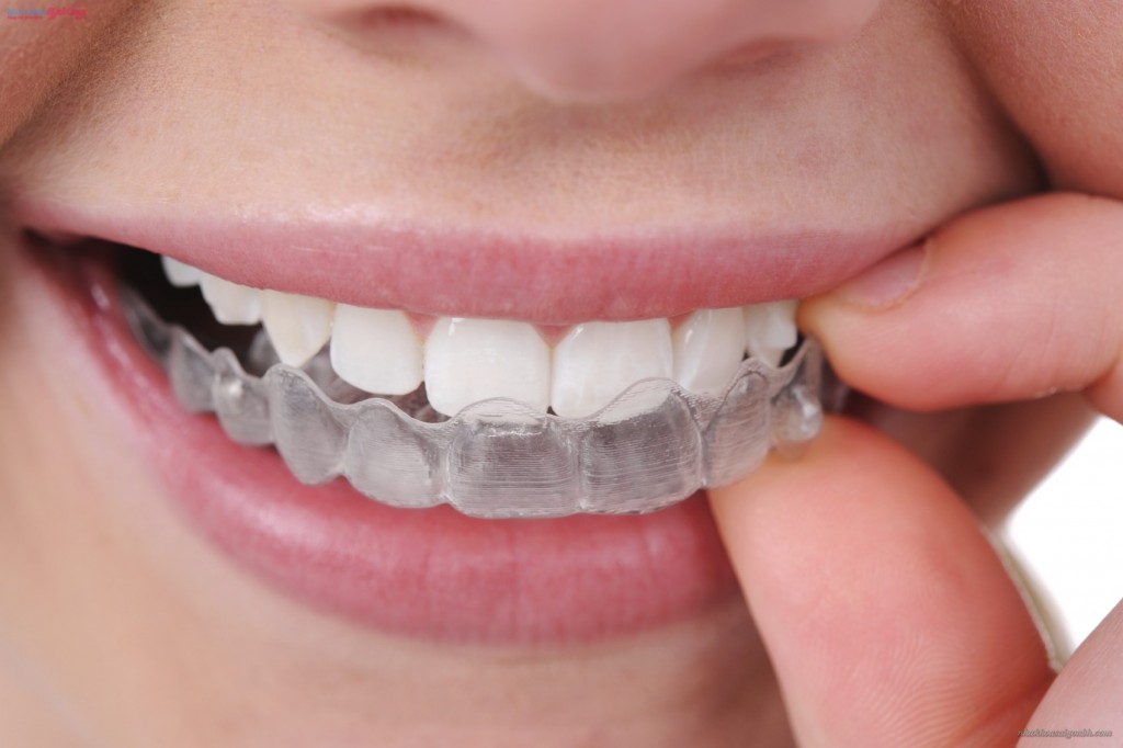 cách trị nghiến răng ở người lớn