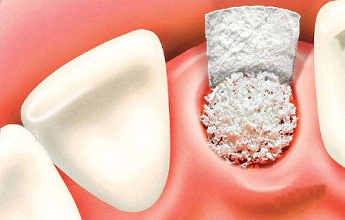 tiêu xương răng là gì 4